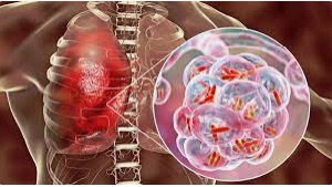 26 - Curso Actualización de la Norma Técnica del Programa de Tuberculosis MINSAL